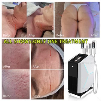SlimSphere Roller meðferð