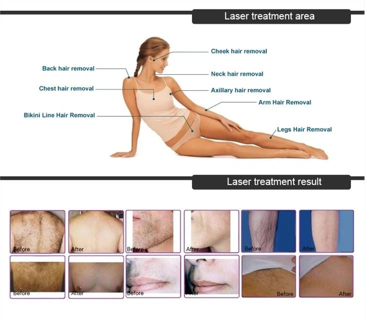 Alma Soprano Ice Titanium Hair Removal Machine